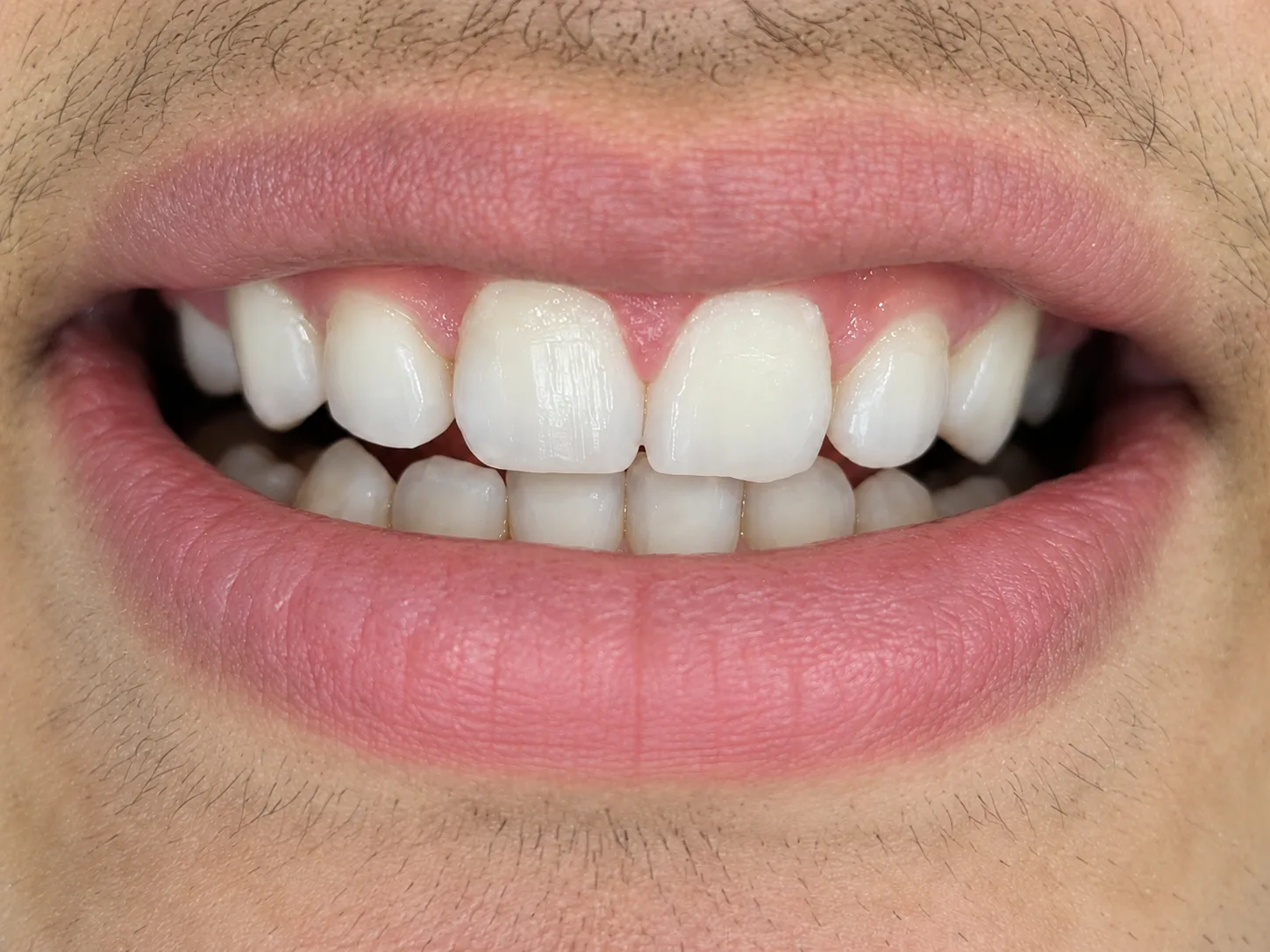 Sonrisa después del tratamiento de estética dental en Panamericana de Odontólogos